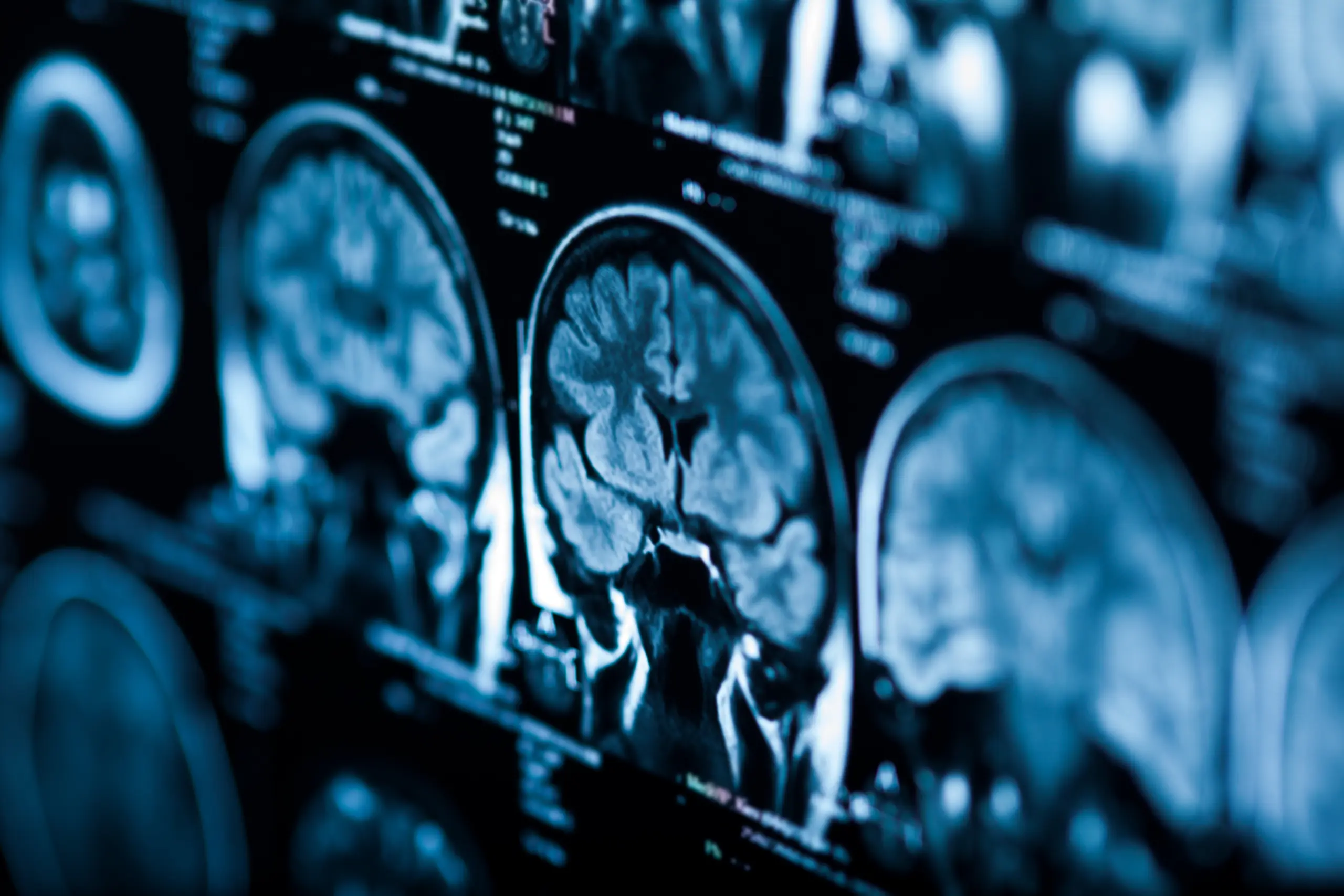 Close-up of brain MRI scans on a medical monitor